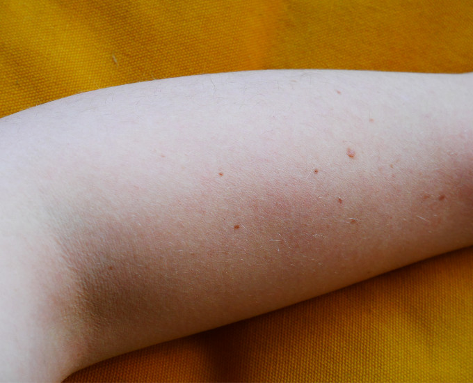 Before arm