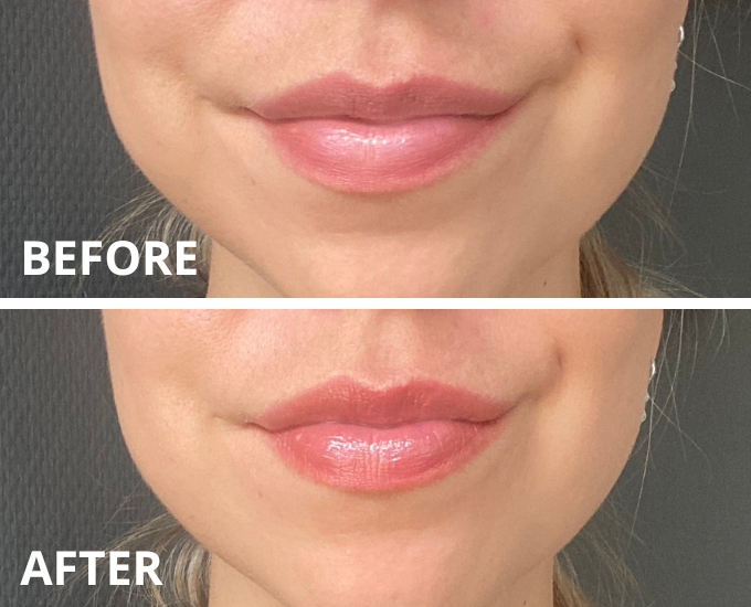 Derol Lip Plumper resultaat result