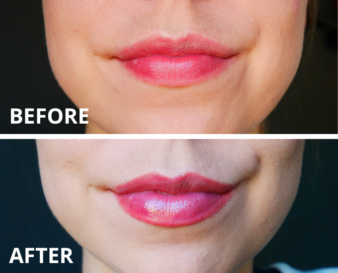 lip plumper resultaat