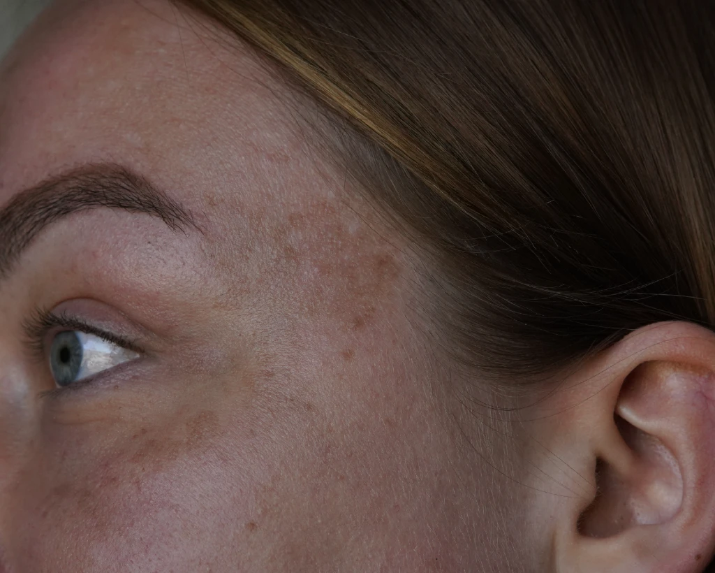 Before Anti Pigment Serum